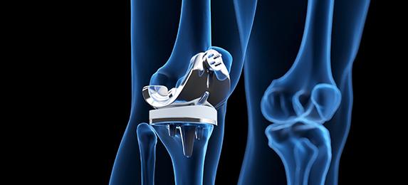 인공관절 클리닉 관련 이미지