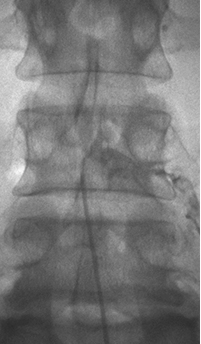 신경성형술 이미지 3